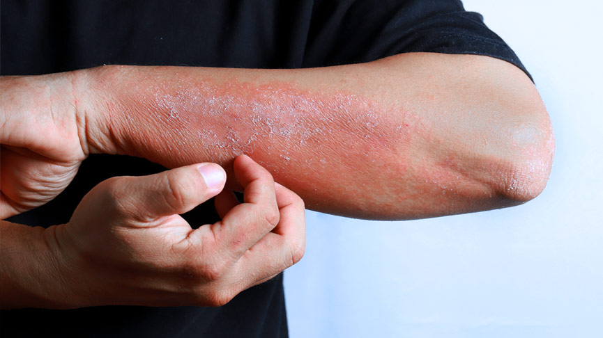 O que é Eczema: quais são as causas do eczema e sintomas do eczema