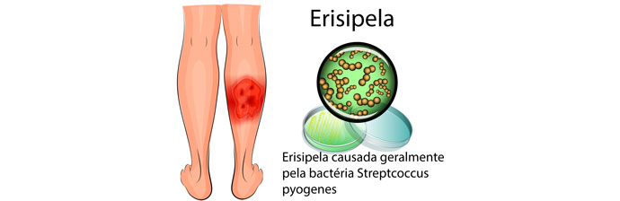 Erisipela: o que é a erisipela e como tratar a erisipela
