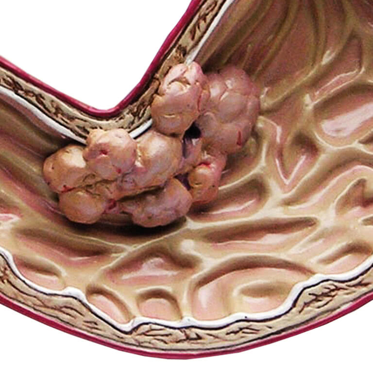 Câncer de estômago Causas, sintomas e